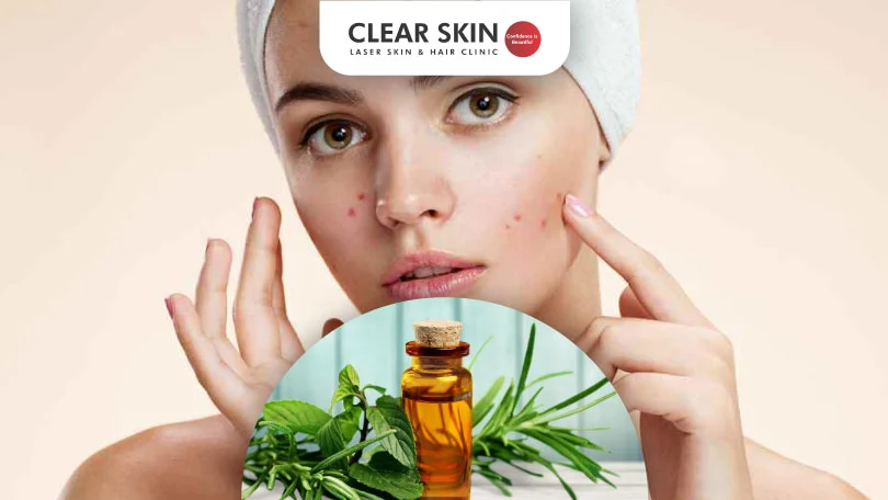 Clear Skin in a Bottle: How to Use Tea Tree Oil to Fight Stubborn Acne