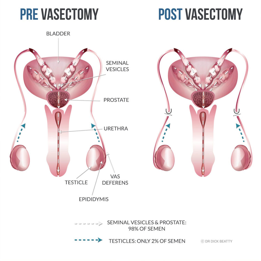 Shared Responsibility: The Profound Impact of Vasectomy on Relationship Longevity