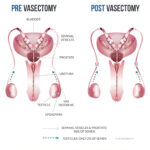 Shared Responsibility: The Profound Impact of Vasectomy on Relationship Longevity