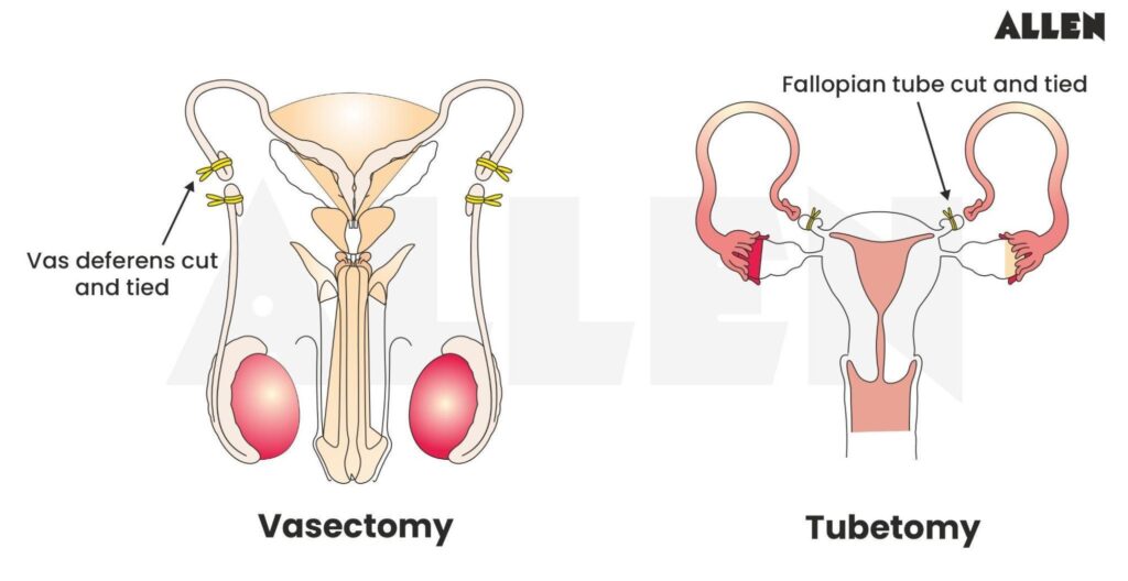 Tubectomy vs. Vasectomy: Comparing Benefits for the Modern Couple