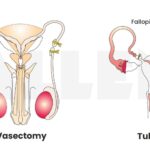 Tubectomy vs. Vasectomy: Comparing Benefits for the Modern Couple