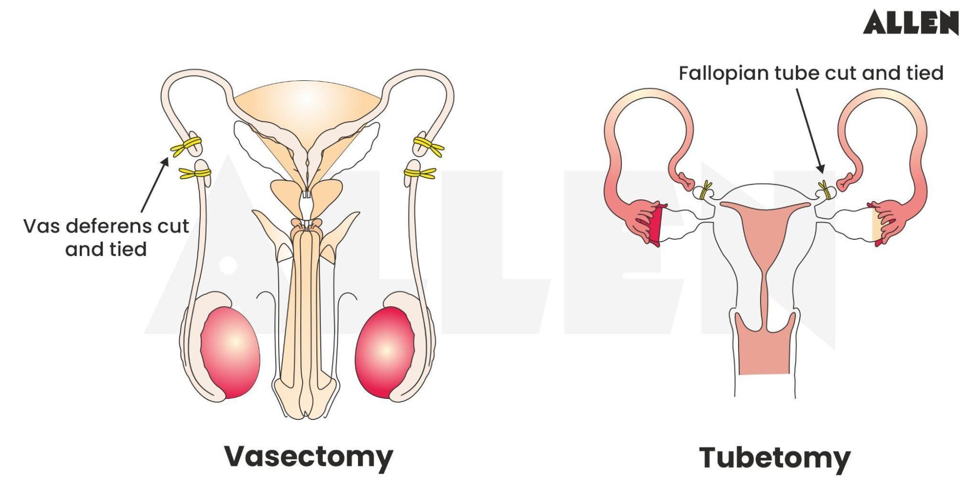 Tubectomy vs. Vasectomy: Comparing Benefits for the Modern Couple